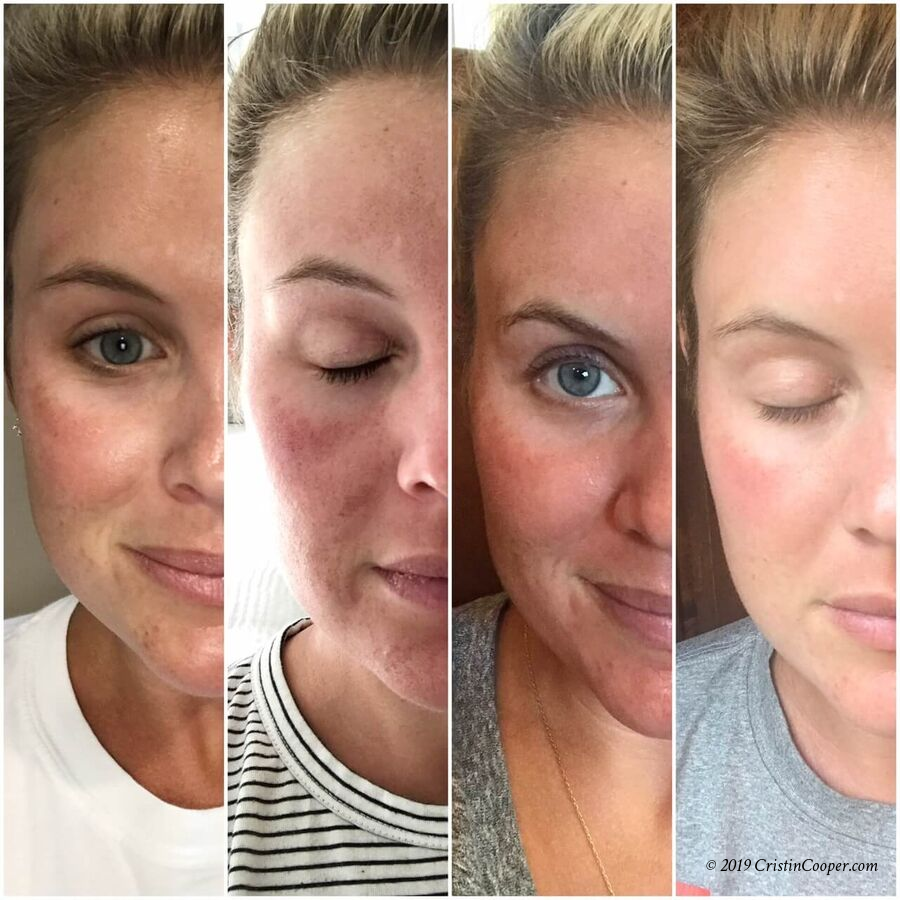 Laser Treatment Microneedling Results The Southern Style Guide