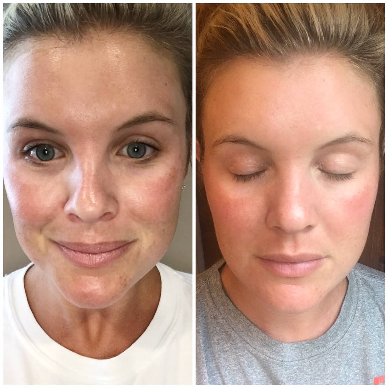 CO2 micro ablative laser treatment and microneedling, sweetgrass plastic surgery, charleston sc - Laser Treatment + Microneedling Results featured by popular South Carolina beauty blogger, The Southern Style Guide