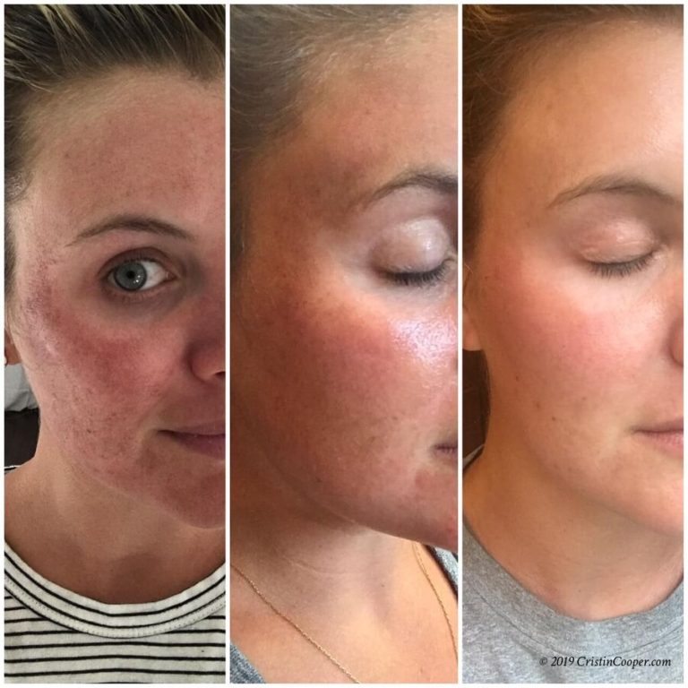 Laser Treatment & Microneedling Results The Southern Style Guide